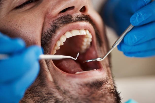 Best Emergency Treatment for Dental Infections or Abscesses in Bayonet Point, FL